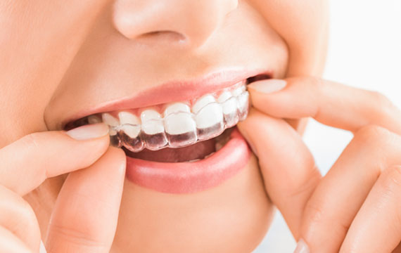 Teeth Whitening Stittsville